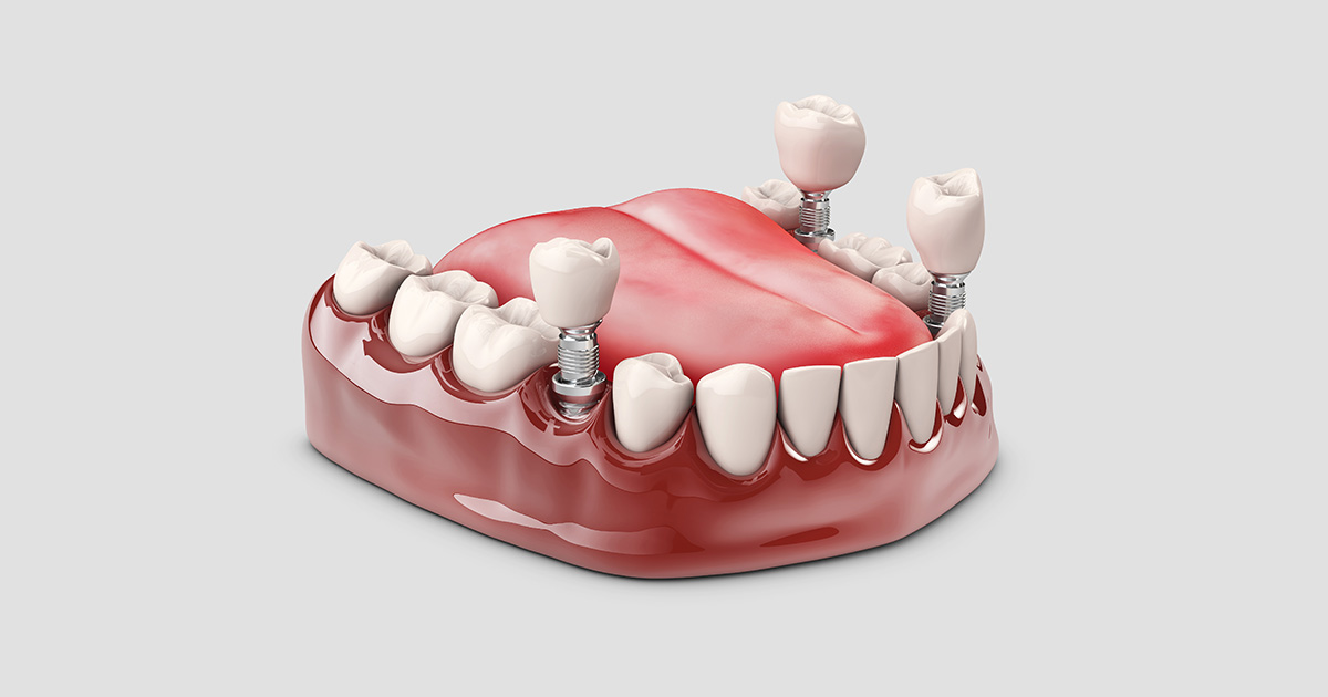 Vantagens da cirurgia guiada na Odontologia