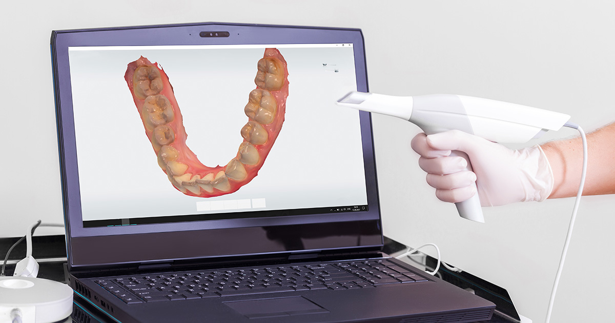 scanner no sistema CAD/CAM para odontologia