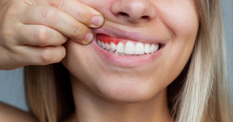 Diagnósticos mais comuns associados ao sangramento na gengiva