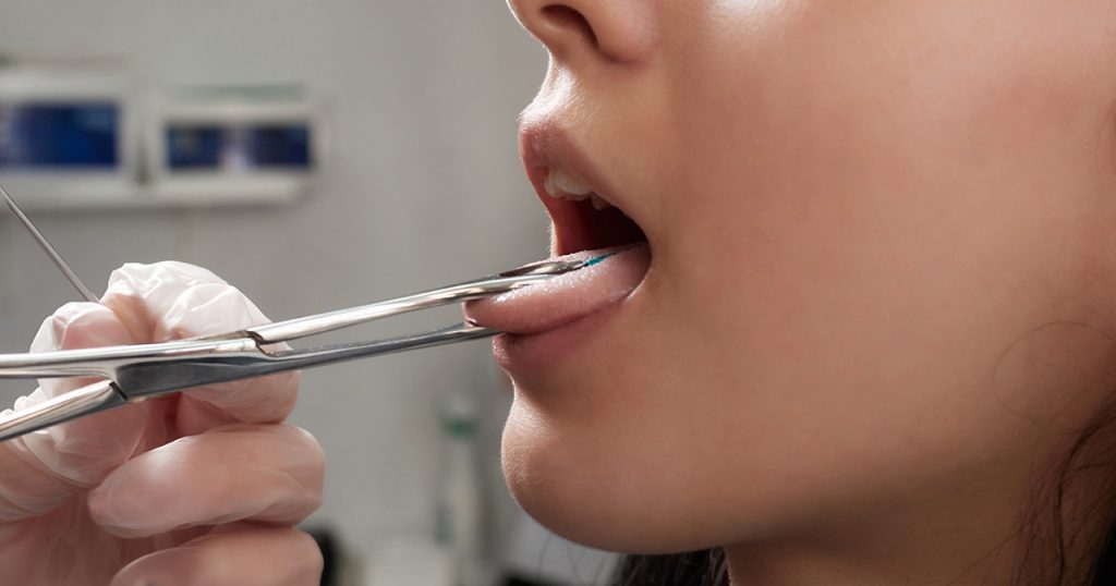 Como o piercing na língua afeta a saúde bucal